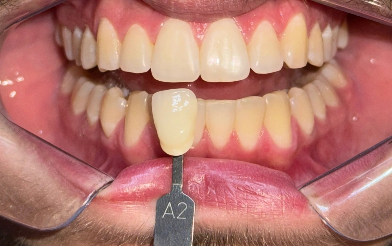 Depois — Clareamento Dental